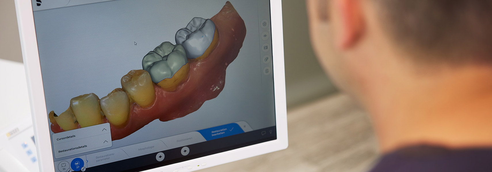 Zahnersatz / Inlays an einem Tag (CEREC®)